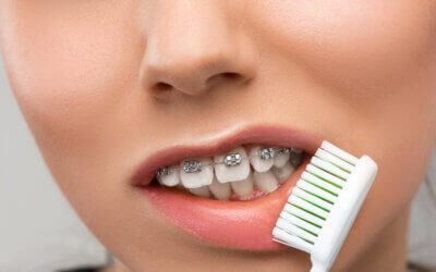 Cinci sfaturi pentru a supravieţui primei săptămâni cu aparatul dentar